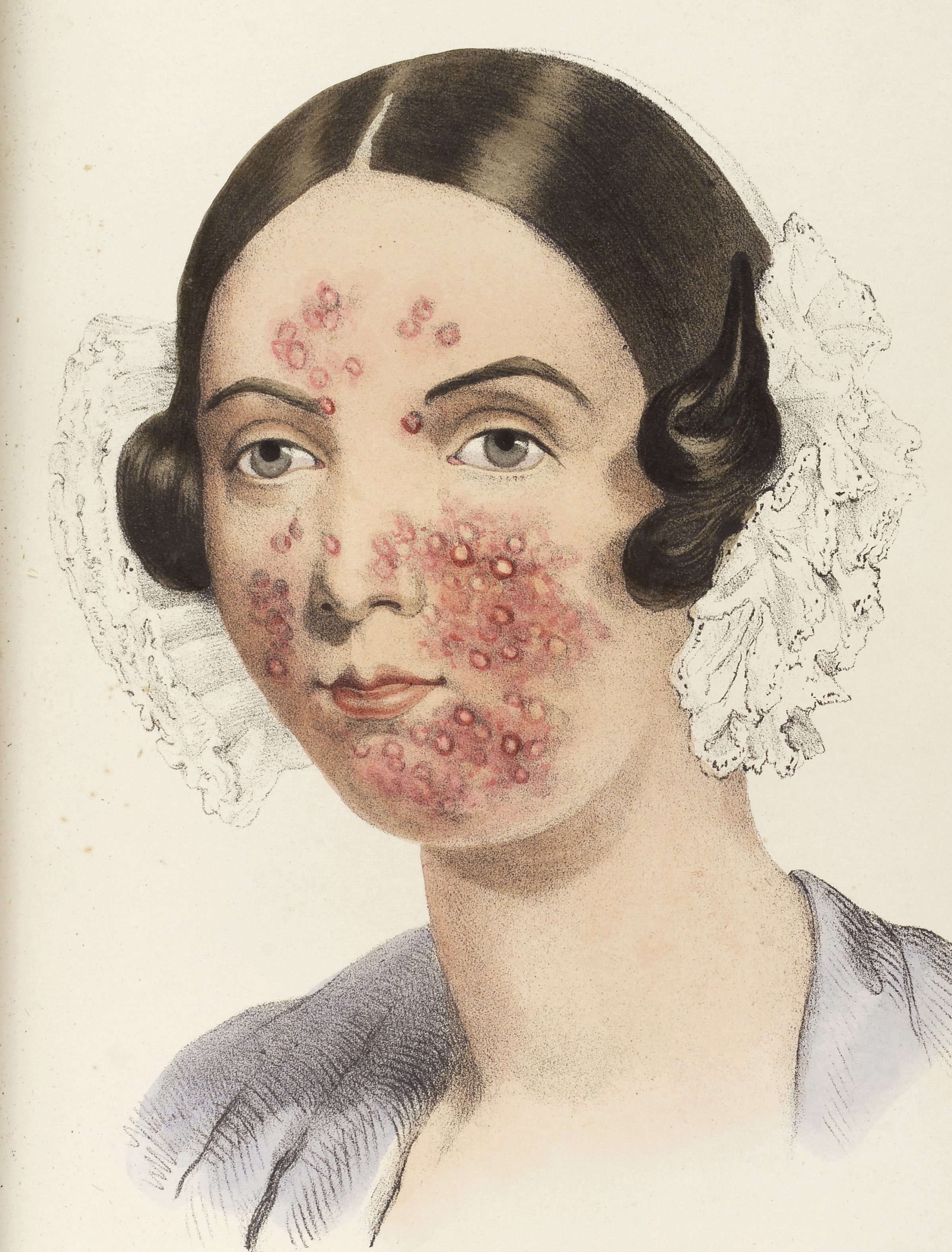 L0037455 Illustration of a woman with acne on her face
